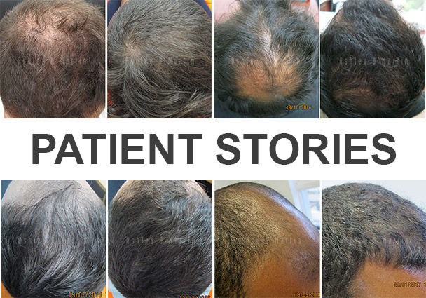Case Study: Family member urges client to get help for his hair loss and  results start to show four months later | Ashley and Martin Perth
