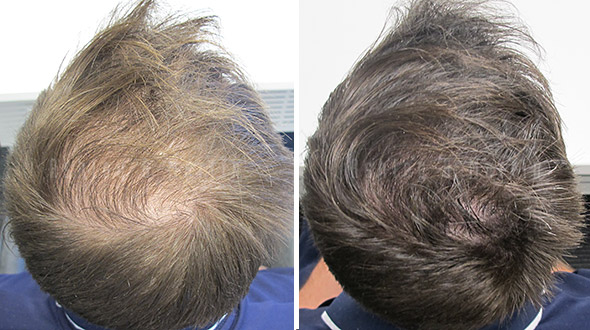 Case Study: Client feels 'great' about the very easy solution to his hair  loss problem | Ashley and Martin Perth